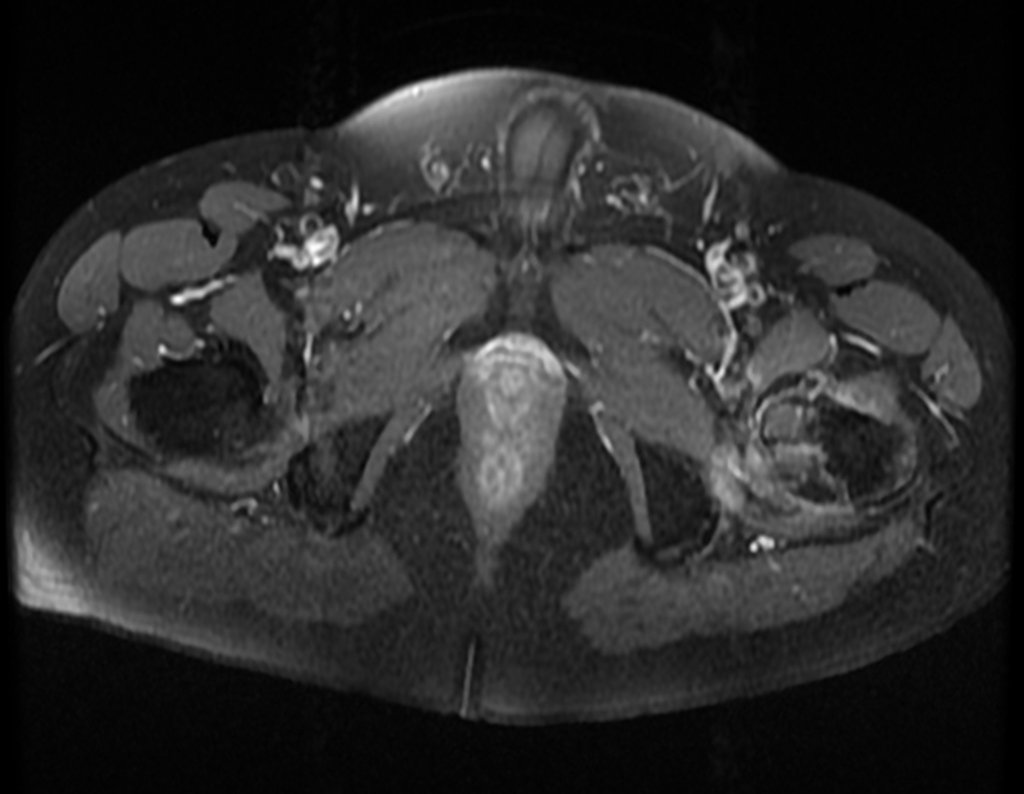 Figura 58: RM com comprometimento da metáfise femoral.