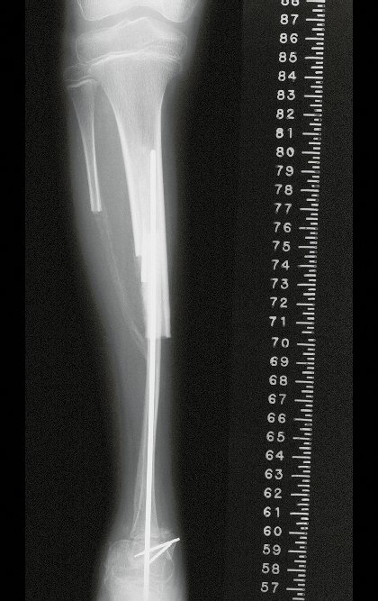 Figura 33: Radiografia frente, após três meses da reconstrução.