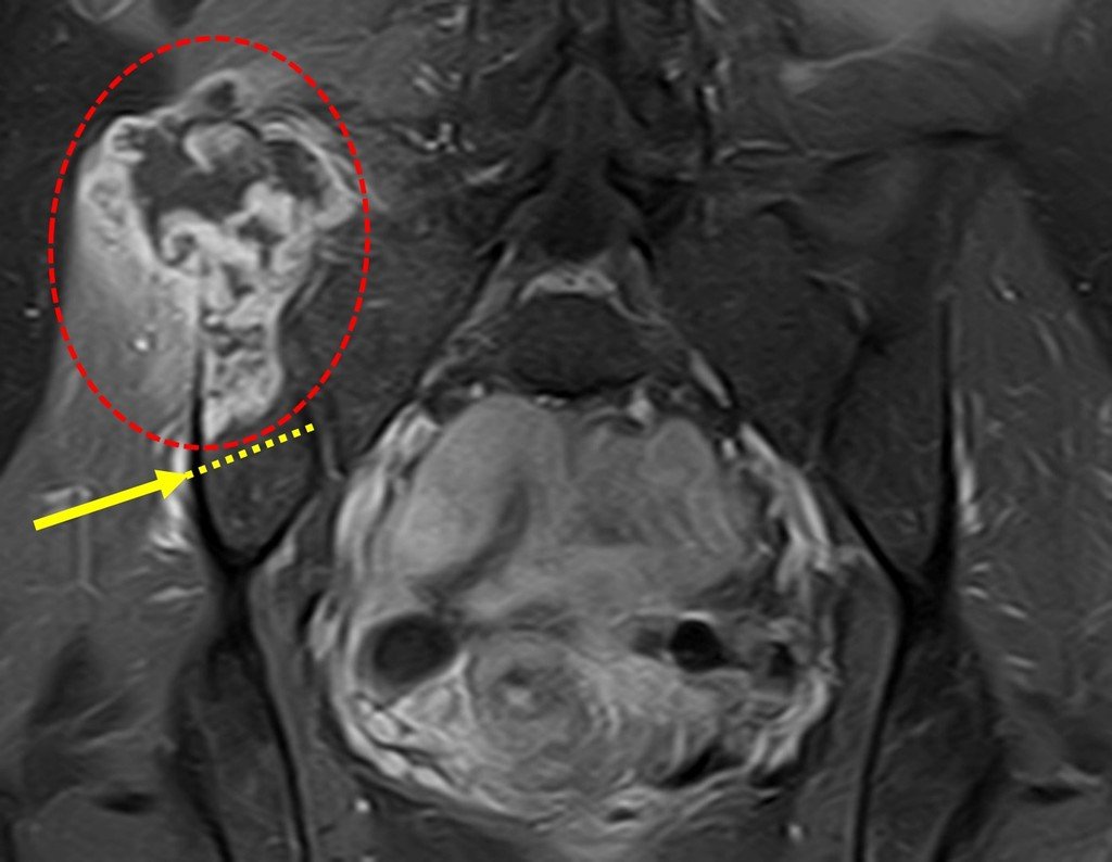 Figura 92: Ressonância coronal destacando a lesão, círculo vermelho e o plano de corte planejado, seta amarela.