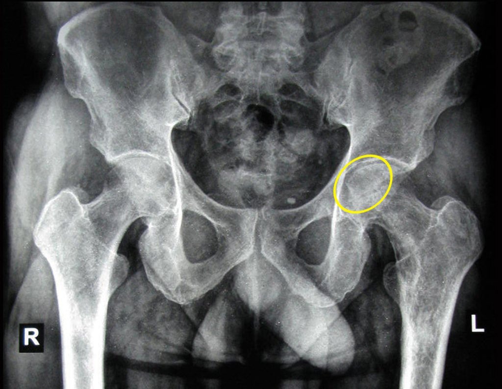 Figura 62: Radiografia de 20/07/2015 com rarefação óssea na cabeça femoral, e na região medial do fêmur.