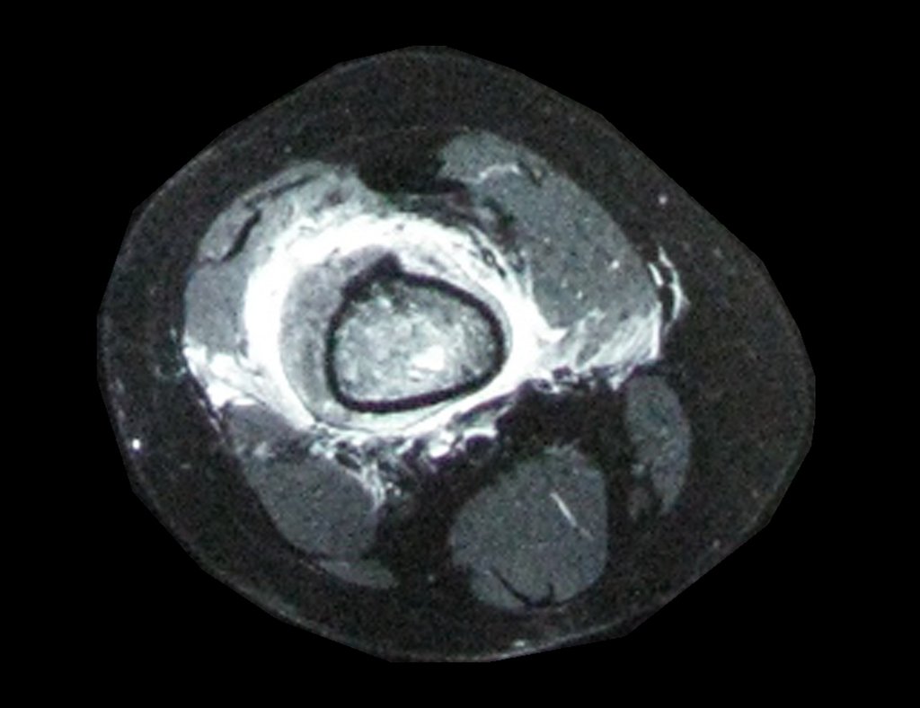 Figura 16: RM axial fat T1, com intensa captação de gadolínio, corte mais proximal.