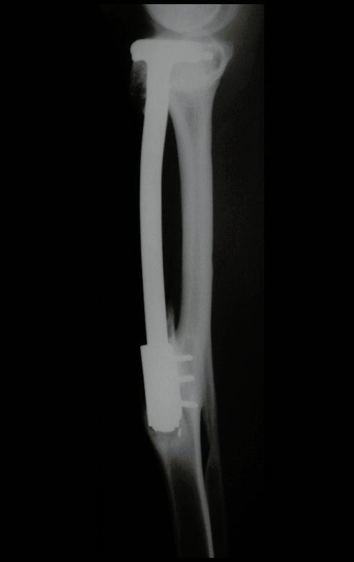 Figura 124: Radiografia perfil, de 21/10/2002, após três anos, boa hipertrofia da fíbula e alinhamento do membro operado.