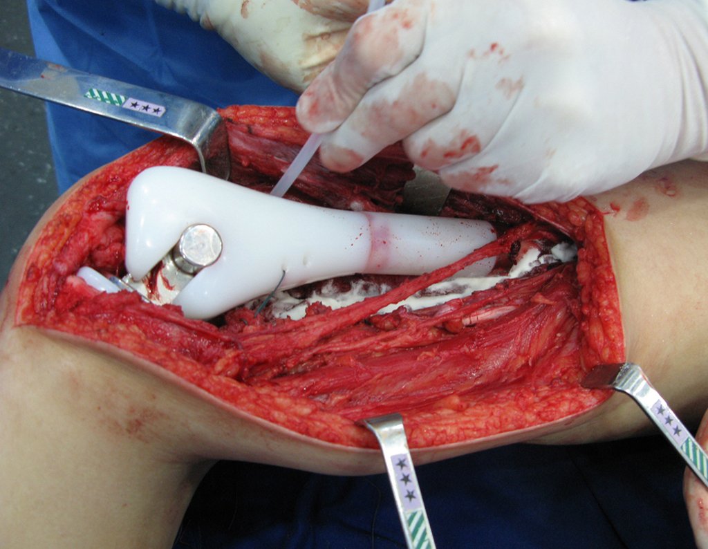 Figura 92: Revisão da hemostasia.