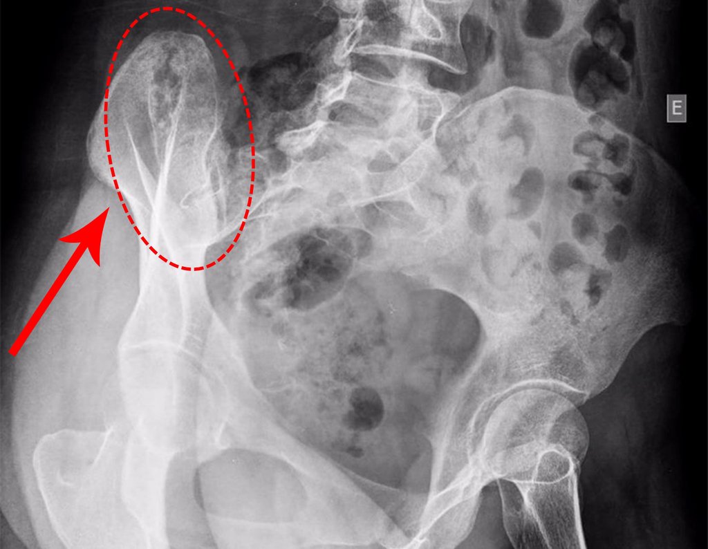 Figura 87: Radiografia de bacia obturatriz com lesão na crista ilíaca direita, seta e círculo em vermelho.