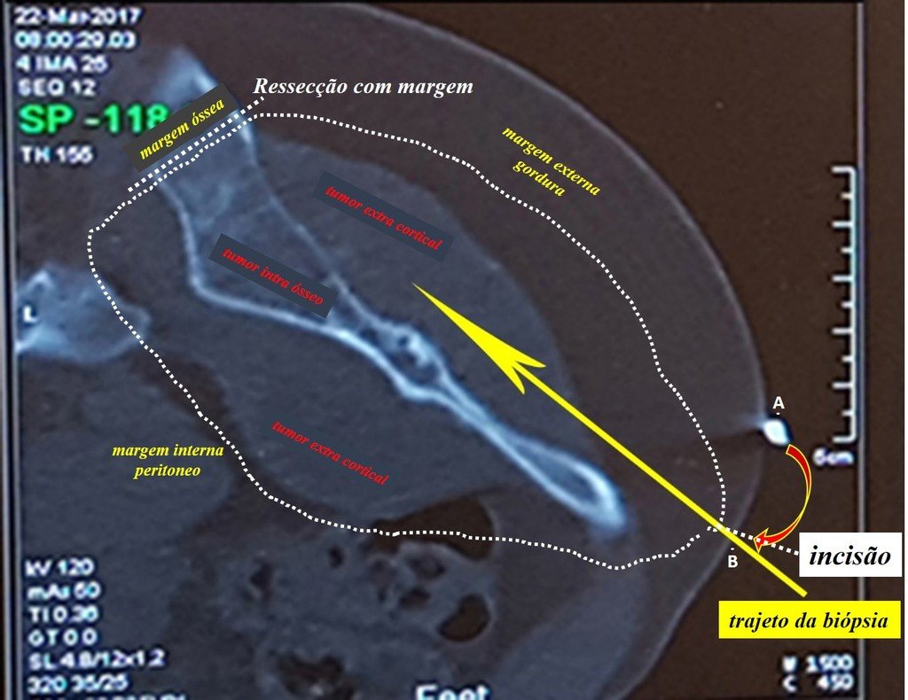 Figura 100: Tomografia com esquema detalhando o planejamento da ressecção, com margem oncológica, incluindo o trajeto da biópsia.