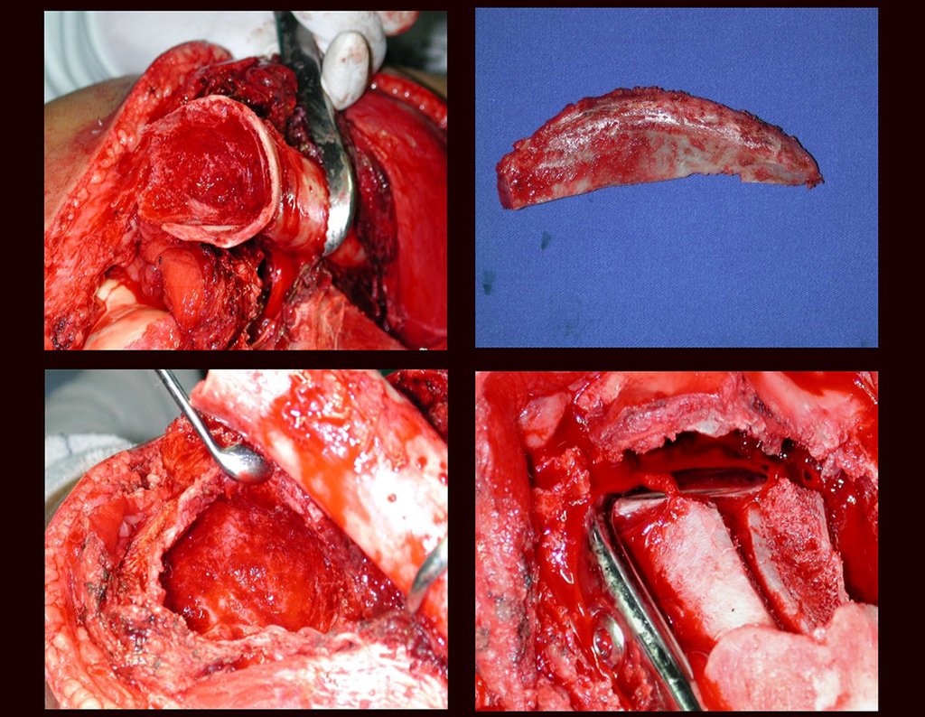 Figura 52: Aspecto intraoperatório após a curetagem da lesão na diáfise, metáfise e epífise femoral. Segmento de enxerto estrutural retirado da crista ilíaca e reconstrução com placa angulada. A lâmina da placa é apoiada pelo enxerto, que mantem a distância entre a epífise e o segmento proximal.