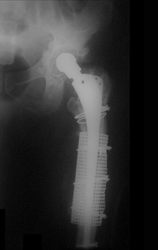 Figura 8: Nova revisão, com troca da prótese femoral, agora com haste longa, em junho de 2009, quarta cirurgia.