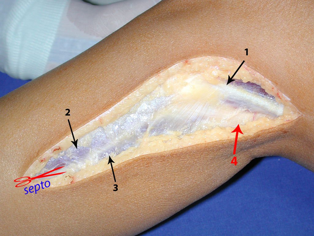 Figura 61: O septo deve ser aberto cuidadosamente, para expor as seguintes estruturas: 1= tendão longo do bíceps; 2= músculo extensor longo dos dedos; 3= músculo flexor longo dos dedos e 4= nervo ciático.