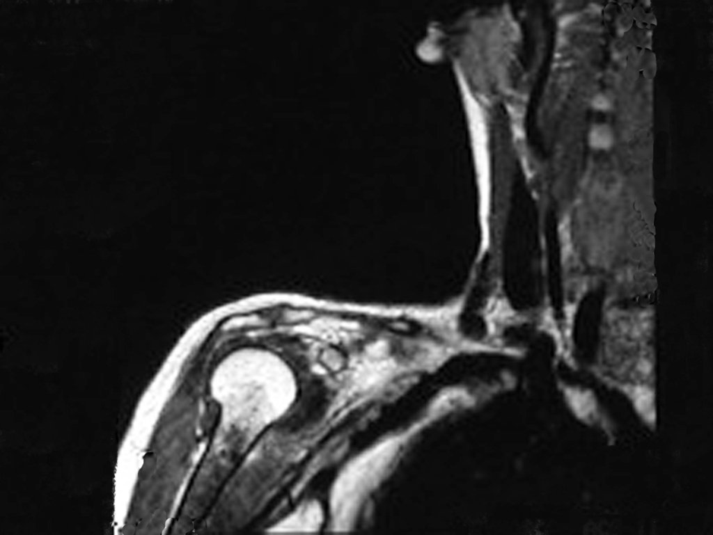 Figura 3: RM com lesão na metáfise proximal do úmero direito, apresentando sinal intermediário e áreas de baixo sinal em T1, que devem corresponder a focos de calcificação.