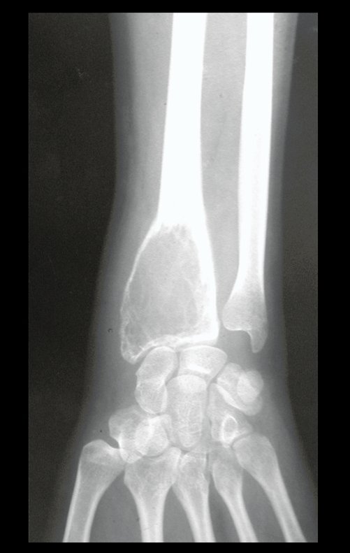 Figura 1: Lesão de rarefação óssea epifisária do rádio, com abaulamento da cortical radial e anfractuosidades. A cortical do lado ulnar encontra-se preservada.