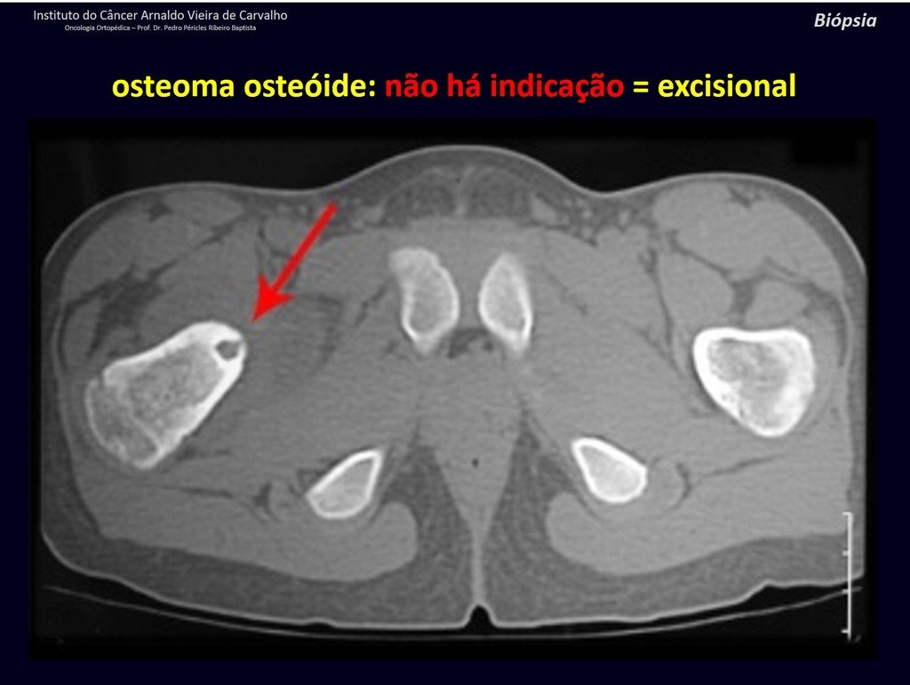 Figura 21: Tomografia com osteoma osteóide na região medial do colo femoral. Neste caso a marcação coincidiu com o centro da lesão, o que facilita, mas não é o ideal, pois perfura a lesão.