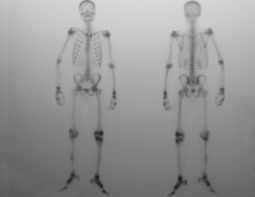 Figura 85: Cintilografia de 06/02/2001, após um ano e três meses, mostra a vitalidade da fíbula transplantada e a vitalidade da sua placa de crescimento.