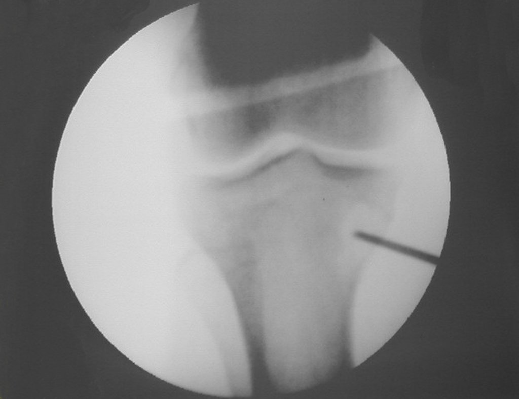 Figura 20: Biópsia com agulha de Jamshidi e controle por radioscopia.