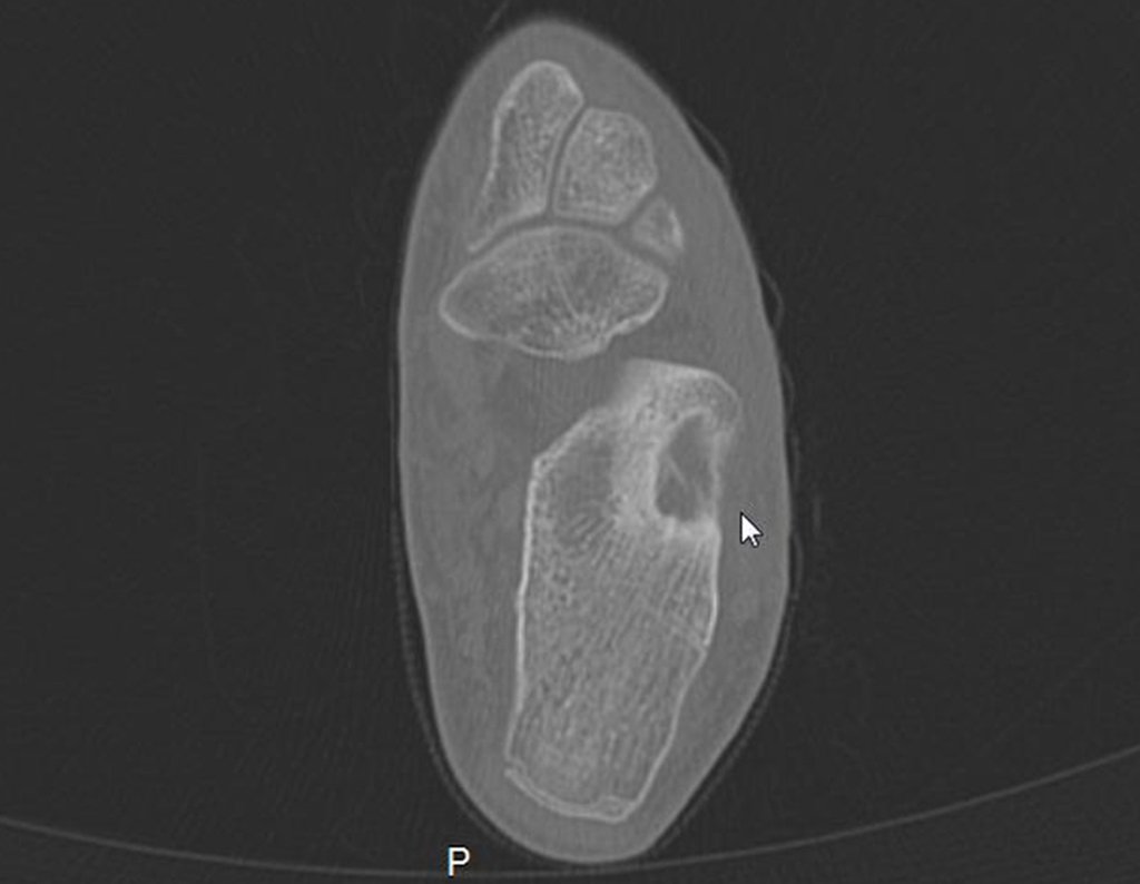 Figura 17: TC, corte axial, com a presença da imagem lítica e halo de esclerose.