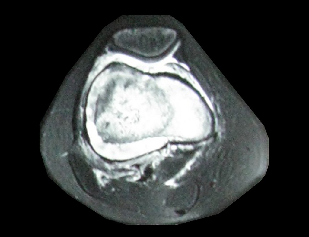 Figura 15: RM axial fat T1, com intensa captação de gadolínio.