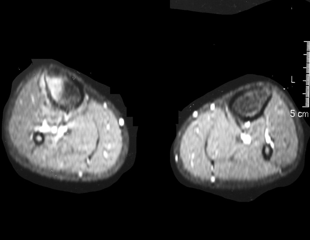 Figura 16: RM axial T1 Spir, corte mais inferior, boa resposta ao tratamento neoadjuvante.