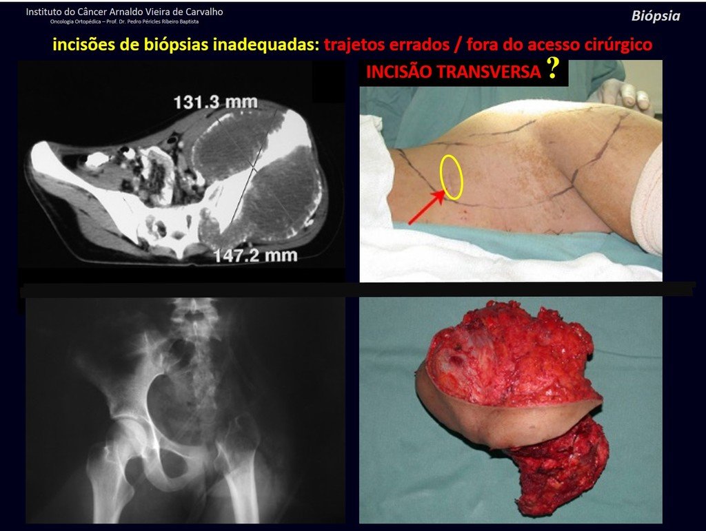 Figura 82: Incisão transversa!!! Trajeto inadequado dificultando a ressecção com margem deste condrossarcoma da pelve. Foi necessária uma ampla ressecção de pele nesta hemipelvectomia interna.