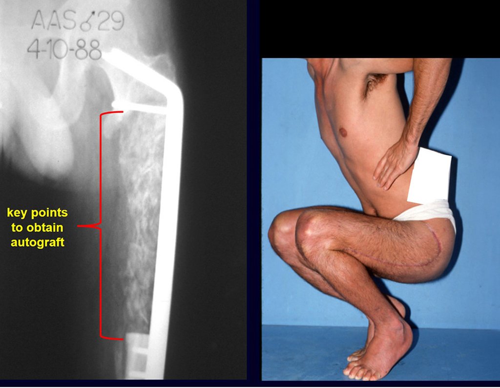 Figura 8: Radiografia de reconstrução com enxerto autólogo obtido de uma única tábua do osso ilíaco. Flexão com carga total após oito meses.