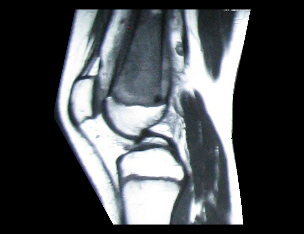 Figura 10: RM sagital T1 com lesão de baixo sinal, ocupando a metáfise femoral e lesão extracortical anterior e posterior no fêmur.