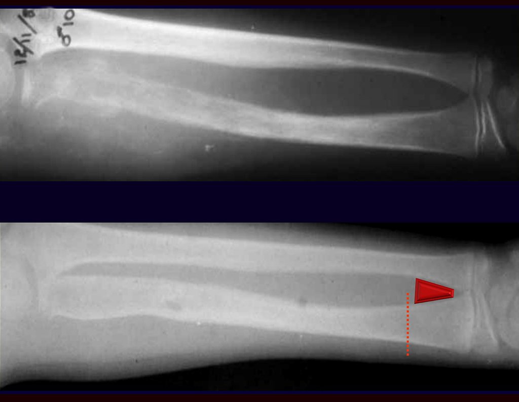 Figura 1: Radiografias do antebraço com lesão nos 2/3 proximais do rádio devido à sarcoma de Ewing, pré quimioterapia acima, e pós quimio pré operatória abaixo.