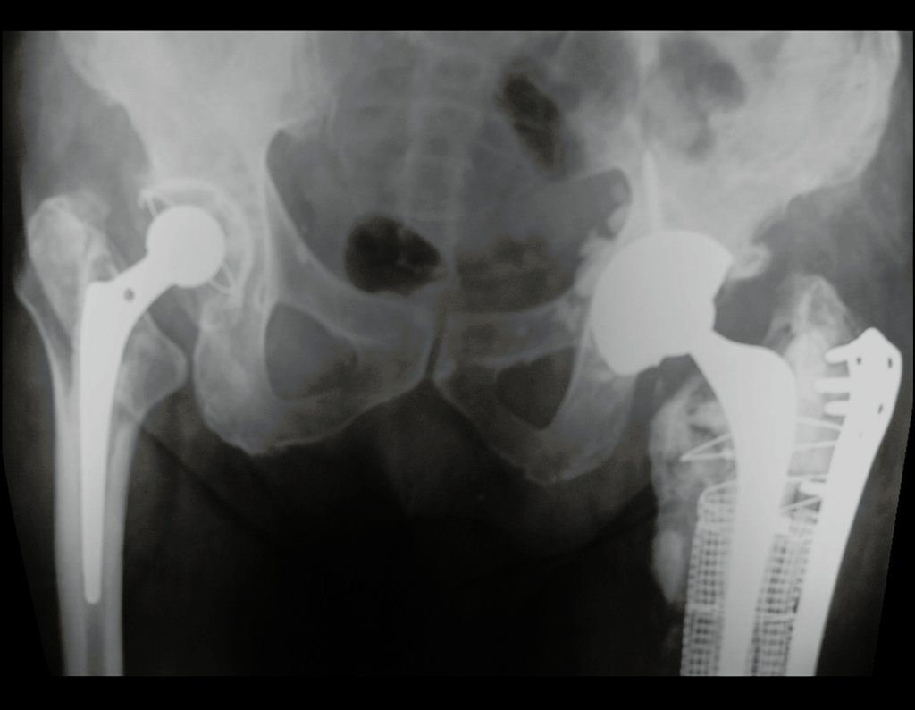 Figura 16: Radiografia pré-operatória da revisão em um tempo de artroplastia infectada do quadril esquerdo.