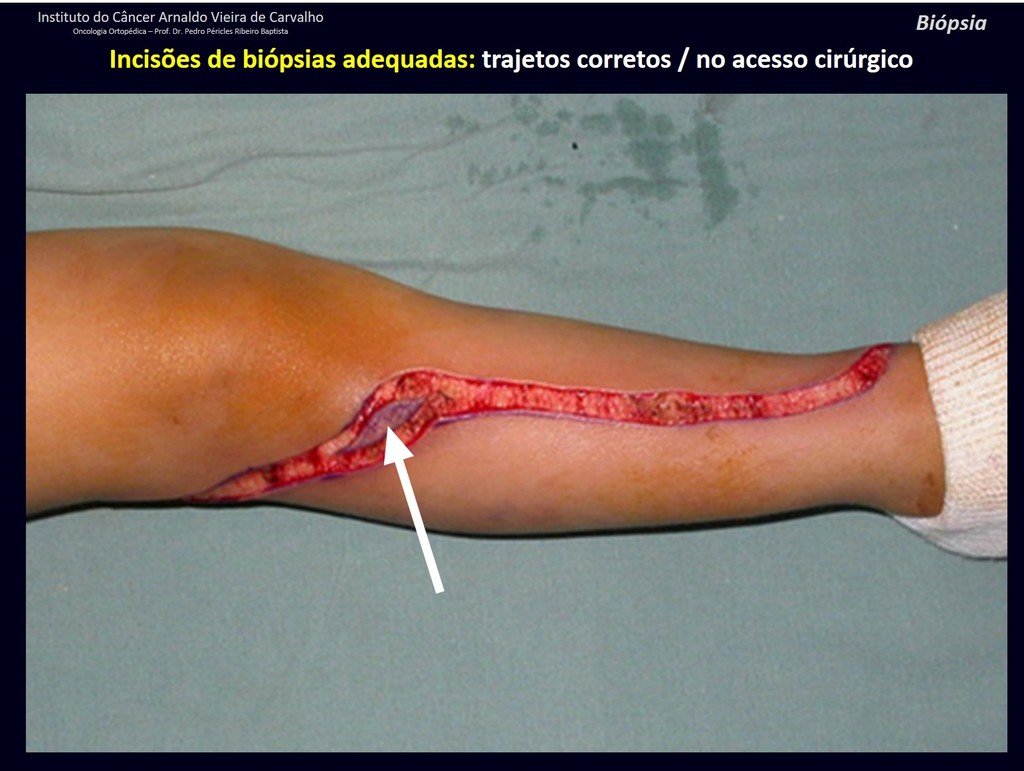 Figura 83: BIÓPSIA CORRETA. Puntiforme, com agulha de Jamshid, permitindo a ressecção do tumor com margem, juntamente com o trajeto da biópsia.