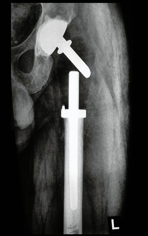 Figura 124: Radiografia do quadril, frente, após sete semanas.