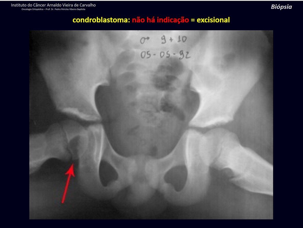 Figura 53: Lesão com matriz cartilaginosa, epifisária, em criança (esqueleto em crescimento), halo de esclerose, com focos de calcificação = CONDROBLASTOMA.