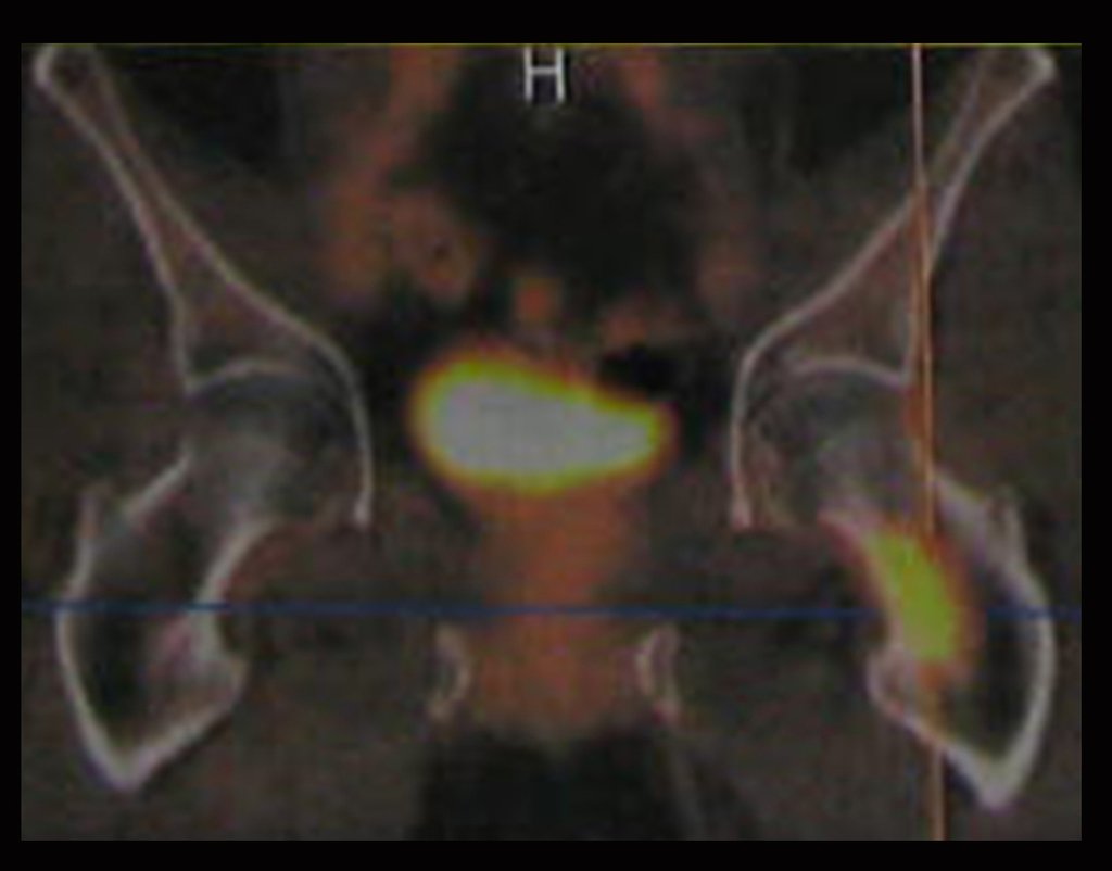 Figura 16: Pet-Ct, para o estadiamento da doença, mostra lesão lítica no trocanter menor esquerdo, SUV = 10,7.