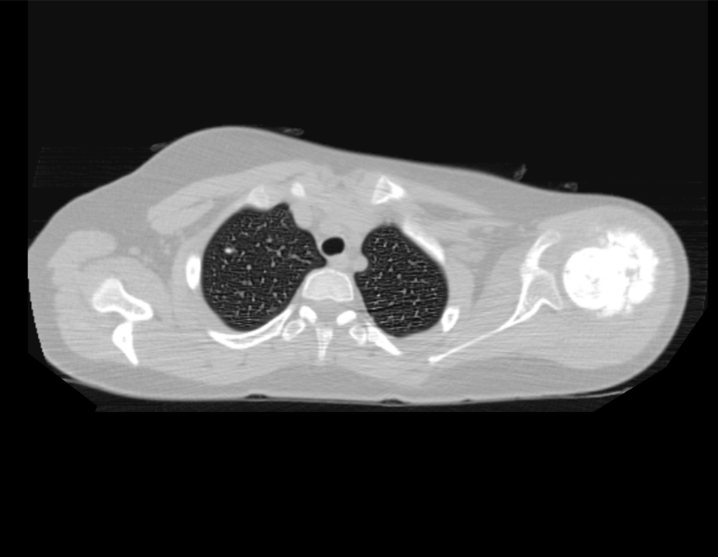 Figura 10: Extenso comprometimento do ombro e musculatura do deltoide.