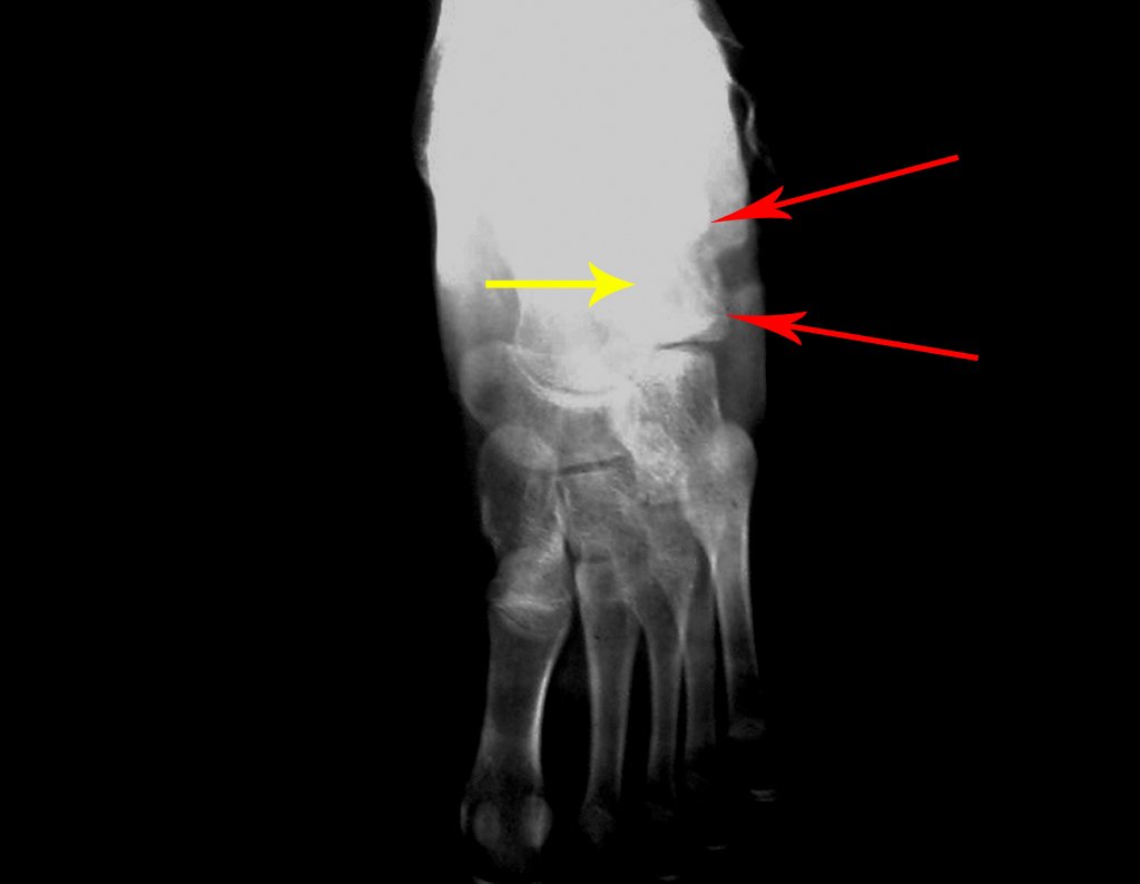 Figura 50: Radiografia do pé esquerdo frente, antes da colocação do enxerto do Ilíaco. As setas vermelhas delimitam o comprimento da área ressecada, e a seta amarela assinala a profundidade do bloco ressecado.