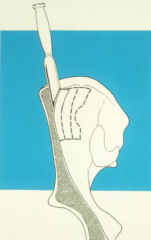 Figura 18: Esquema ilustrativo da retirada da cortical da tábua interna do ilíaco. Vamos retirando a cortical que não está coberta pelo coágulo coletado no fundo.