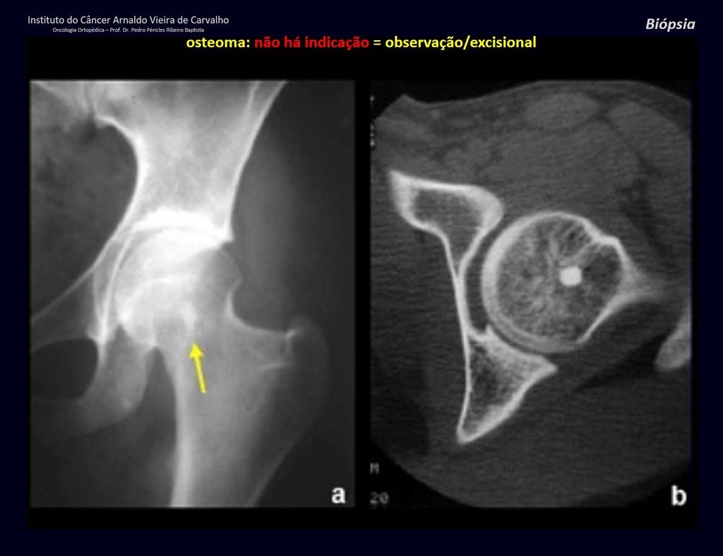 Figura 16: Radiografia com osteoma na cabeça femoral. Enostose assintomática, achado casual em radiografia do quadril.