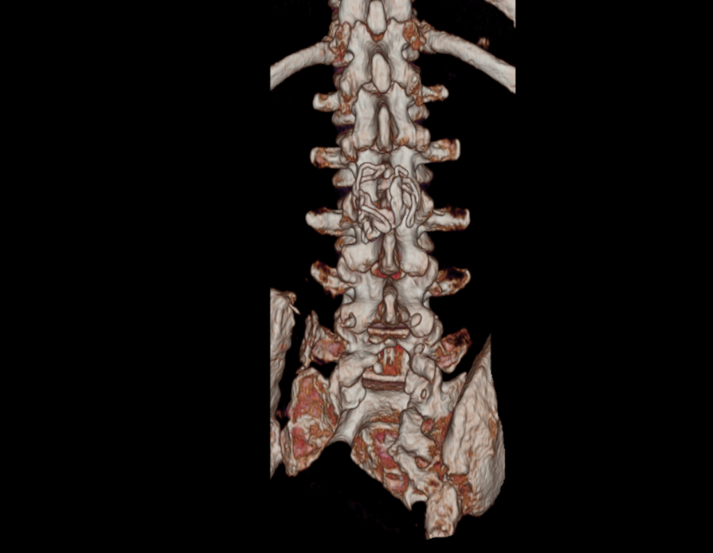 Figura 187: TC 3D vista posterior, evidenciando a ressecção do hemi-sacro, e uma lesão na coluna na região de L4 e L5..