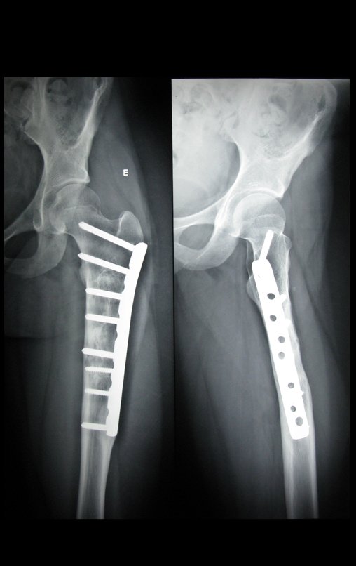 Radiografias do quadril frente e perfil do lado esquerdo Estudo radiográfico da coxa esquerda.