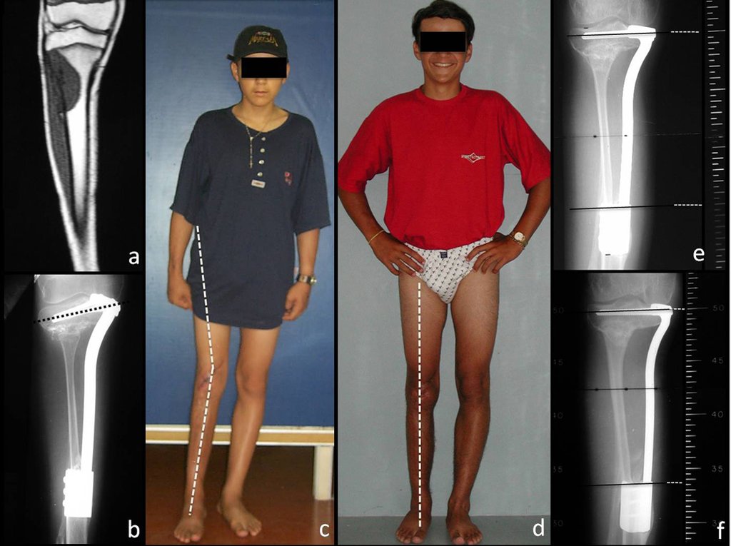 Figura 8: a- ressonância magnética pré-operatória, b- radiografia pós-operatória 4 meses, evidenciando a inclinação dos parafusos da epífise tibial, c- paciente aos 4 meses, com desvio em valgo do joelho, d- paciente com 1 ano e 2 meses, com o valgo corrigido, e- radiografia pós-operatória 1 ano e 2 meses, com hipertrofia da fíbula, correção da inclinação dos parafusos e crescimento de 0,75 cm e f- radiografia pós-operatória 2 ano e 2 meses, com crescimento de 1,2 cm.