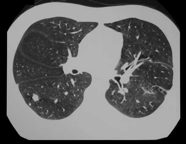 Fig. 13 – tomografia do tórax, com treze anos de evolução.