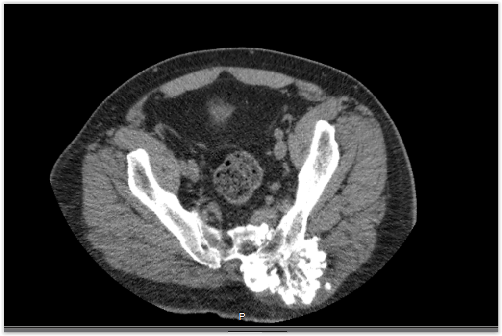 Figura 11: Tomografia com lesão em corte mais distal, com superficie anfractuosa.