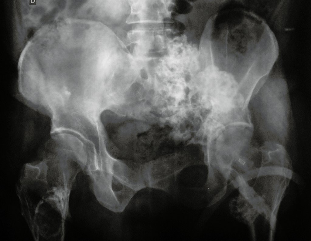 Figura 2: Radiografia de bacia em obturatriz, ressaltando o condrossarcoma na região sacro-ilíaca esquerda.