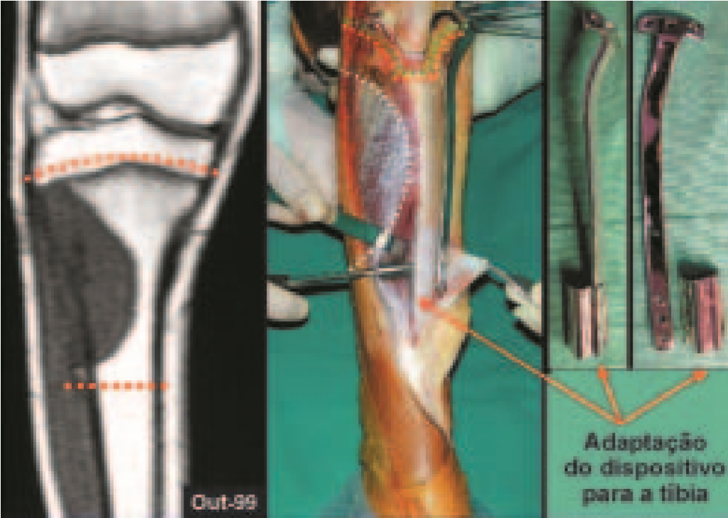 Fig. 9 – R.N.M. determinando nível da ressecção, sacrificando a placa de crescimento da tíbia. Detalhe do periósteo recobrindo a lesão, dissecção do tendão patelar e músculo tibial anterior. Placa especial confeccionada e modelada para o paciente e dispositivo ocluído no extremo distal, com a aba de fixação angulada para adaptar-se ao formato triangular da tíbia.