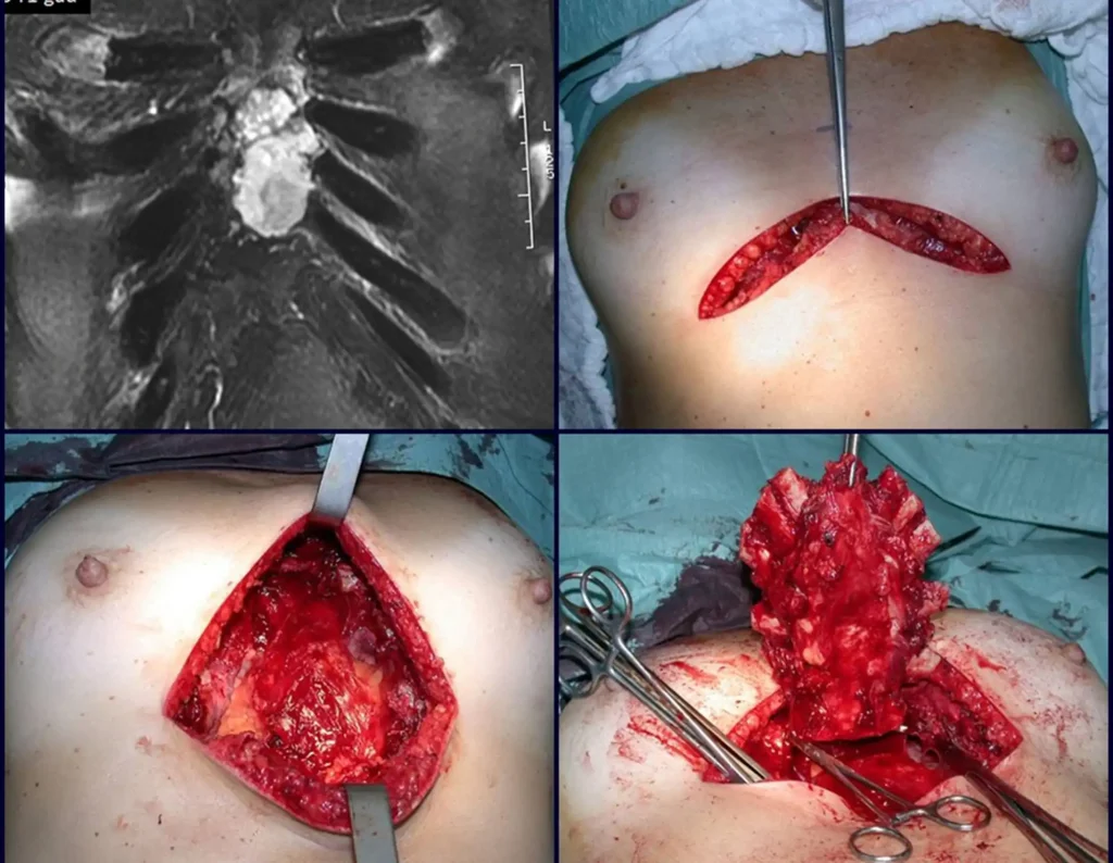 Figura 17: a- Radiografia evidenciando a lesão. b- Incisão realizada na região infra mamária. c- Ressecção do esterno. d- Imagem do local onde foi ressecado o esterno.