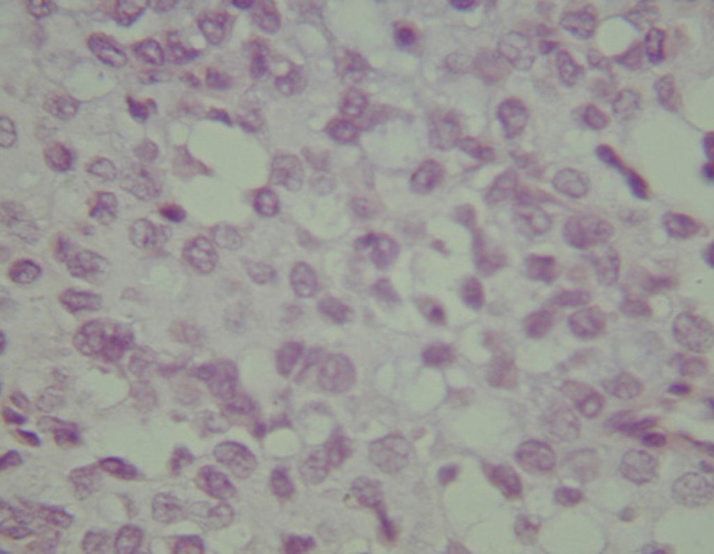 Figura 34: Condrossarcoma grau III, maior celularidade e atipia.