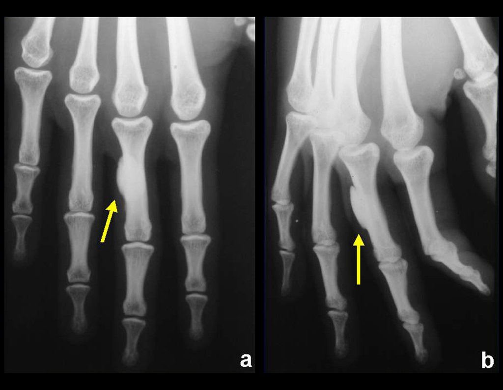 Figura 12: Osteoma da falange proximal, justacortical.