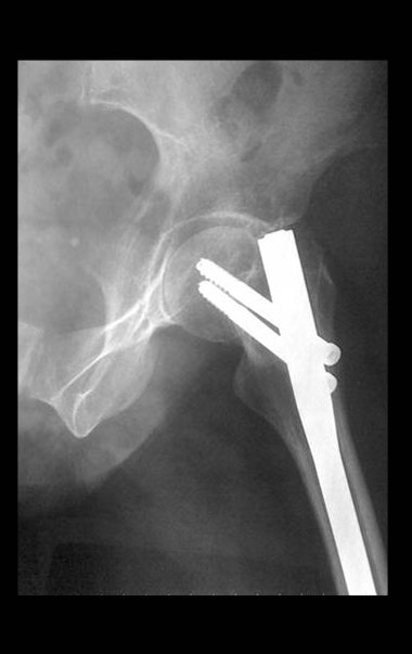 Figura 10: Radiografia do quadril perfil.