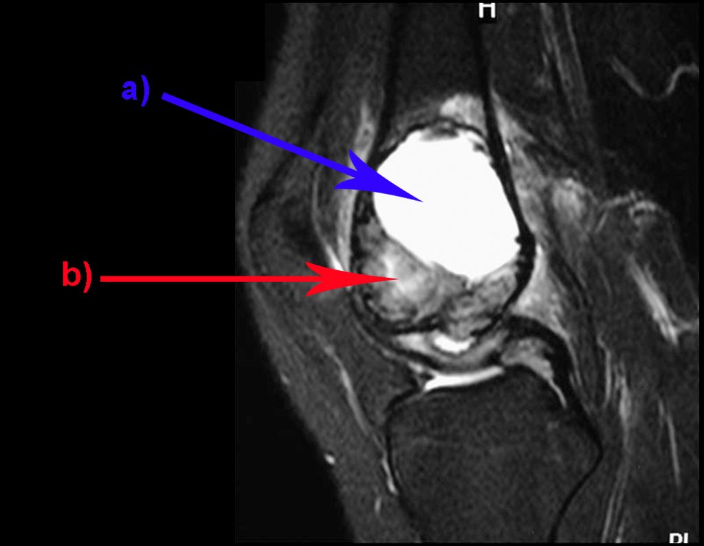 Figura 4: Ressonância magnética, corte sagital, de tumor de células gigantes do fêmur, com área de cisto ósseo aneurismatico. Observa-se que a lesão apresenta áreas de conteúdo líquido (a-COA) e áreas sólidas (b-TGC).