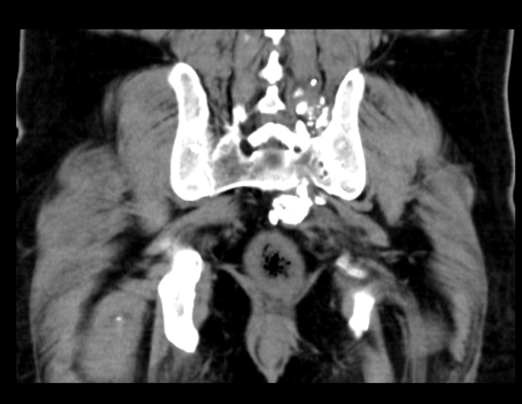 Figura 41: TC coronal, mostrando a lesão afetada na região Sacro-Ilíaca esquerda na altura de L5 - S1.