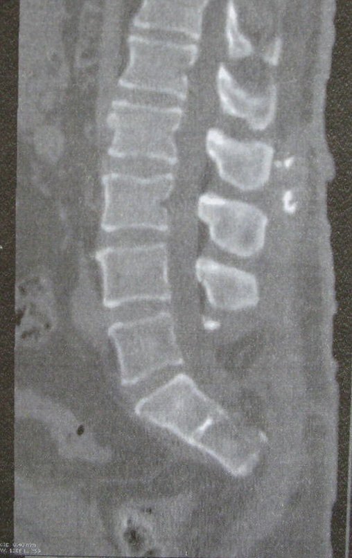 Figura 45: TC sagital da região lombo-sacra, pós operatório de 2 meses.