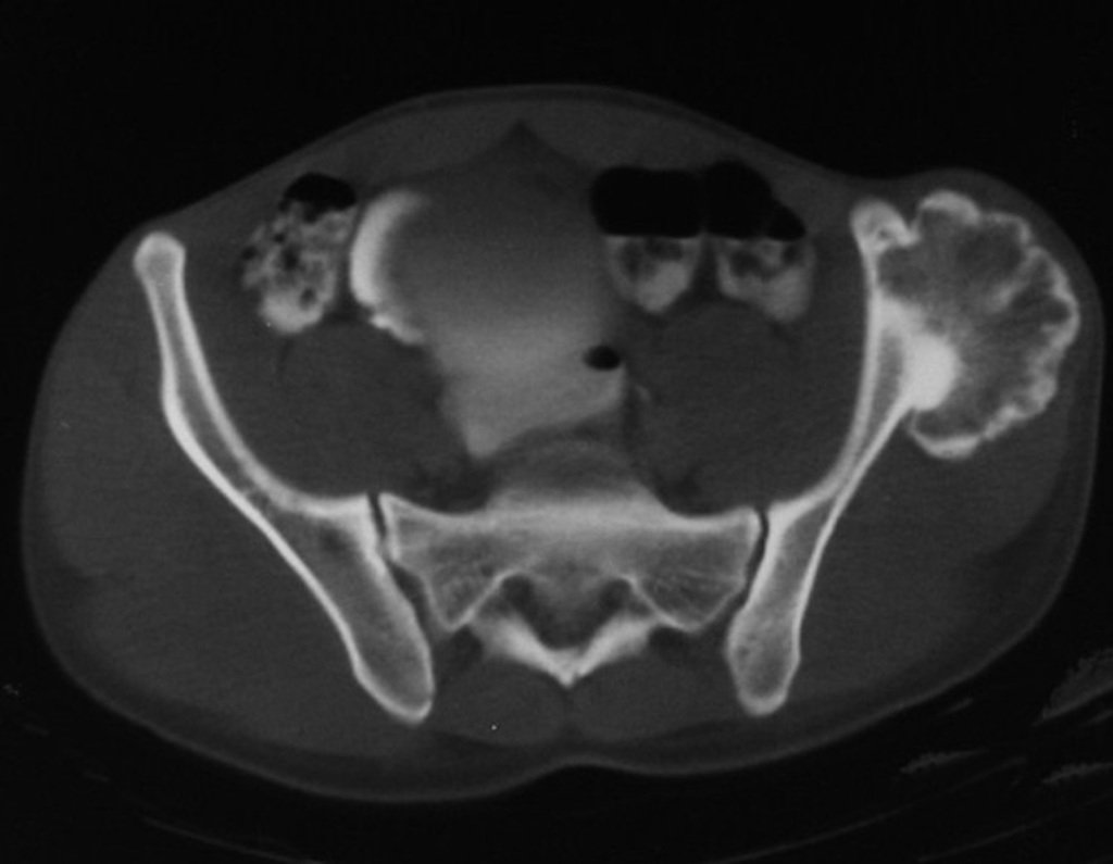 Figura 61: Condrossarcoma secundário à osteocondroma. Na TC observamos o aspecto característico da exostose (cortical do osso continuando-se com a cortical da lesão e a medular do osso com a medular da lesão).