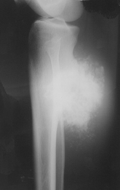 Figura 88: Radiografia mostrando continuidade da lesão com o osso e deformidade da cortical posterior, sugerindo degeneração de osteocondroma.