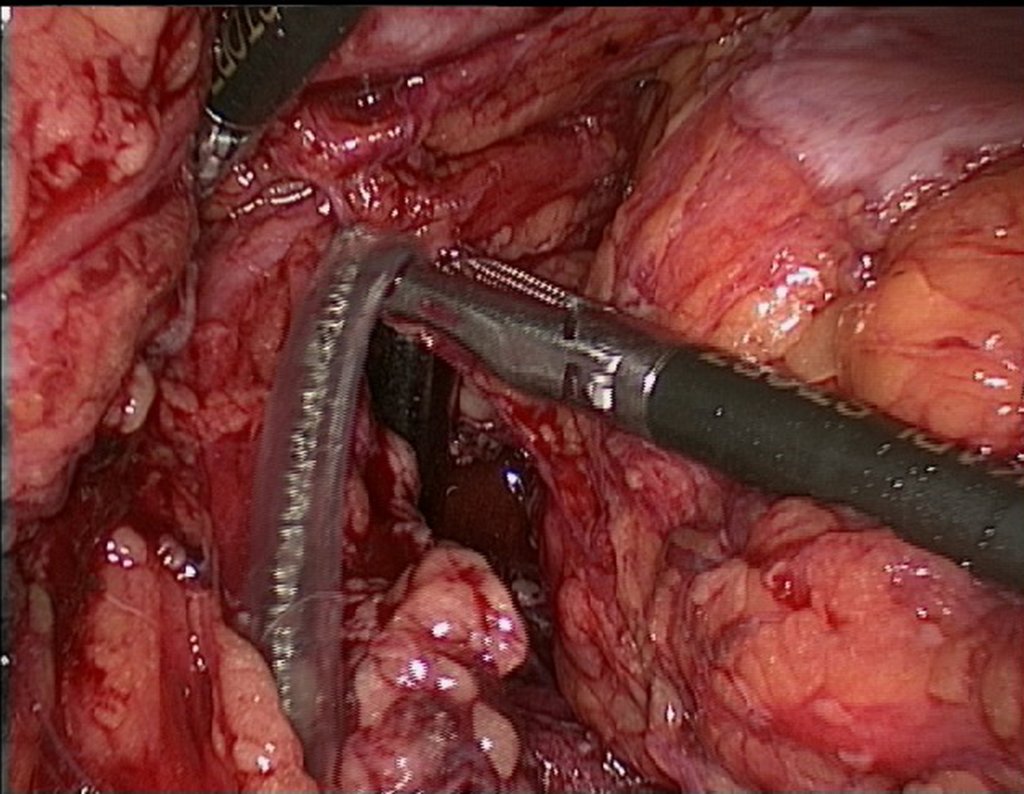 Figura 109: descrição da cirurgia vídeo Laparoscópica.